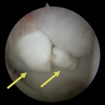 Hock Arthroscopy OCD