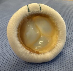 spongy-looking bioprosthetic valve used in open-heart surgery
